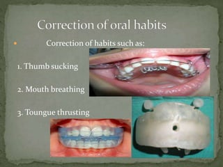  Correction of habits such as:
1. Thumb sucking
2. Mouth breathing
3. Toungue thrusting
 