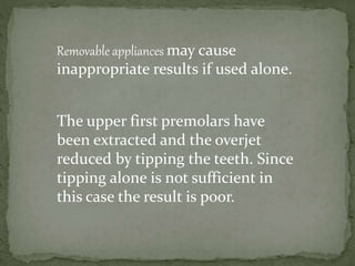 Removable appliances may cause
inappropriate results if used alone.
The upper first premolars have
been extracted and the overjet
reduced by tipping the teeth. Since
tipping alone is not sufficient in
this case the result is poor.
 