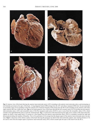 Fig. 5. Anterior view of the heart showing the anterior interventricular artery (AIV) extending in the anterior interventr...