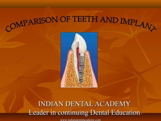 INDIAN DENTAL ACADEMYINDIAN DENTAL ACADEMY
Leader in continuing Dental EducationLeader in continuing Dental Education
www.indiandentalacademy.com
 