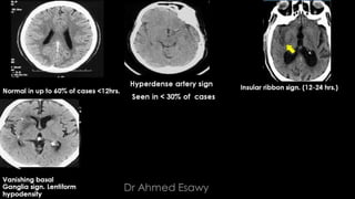 Comparison between ct mri in ischemic stroke | PPTX