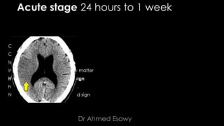 Comparison between ct mri in ischemic stroke | PPTX