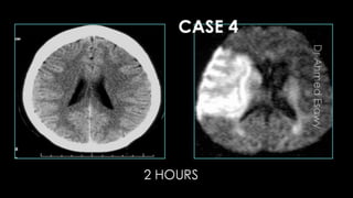 Comparison between ct mri in ischemic stroke | PPTX