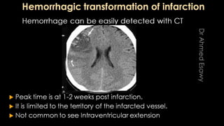 Comparison between ct mri in ischemic stroke | PPTX