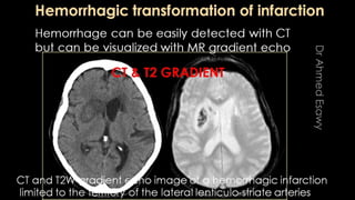 Comparison between ct mri in ischemic stroke | PPTX