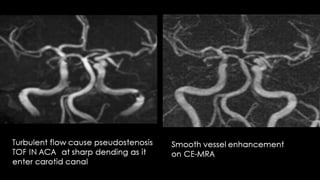 Comparison between ct mri in ischemic stroke | PPTX