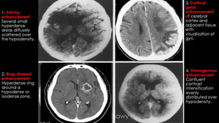 Comparison between ct mri in ischemic stroke | PPTX