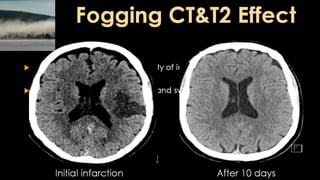 Comparison between ct mri in ischemic stroke | PPTX