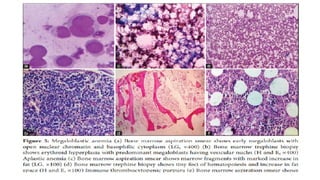 Comparison of BMA and BMB.pptximportant topic for pathology pgs | PPTX