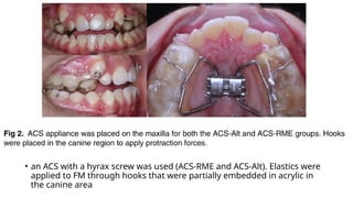 Comparison of the effectiveness of skeletal and tooth-borne.pptx