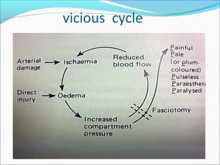 Compartment syndrome basics | PPT