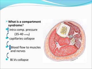Compartment Sy Compartment syndrome basics | PPT