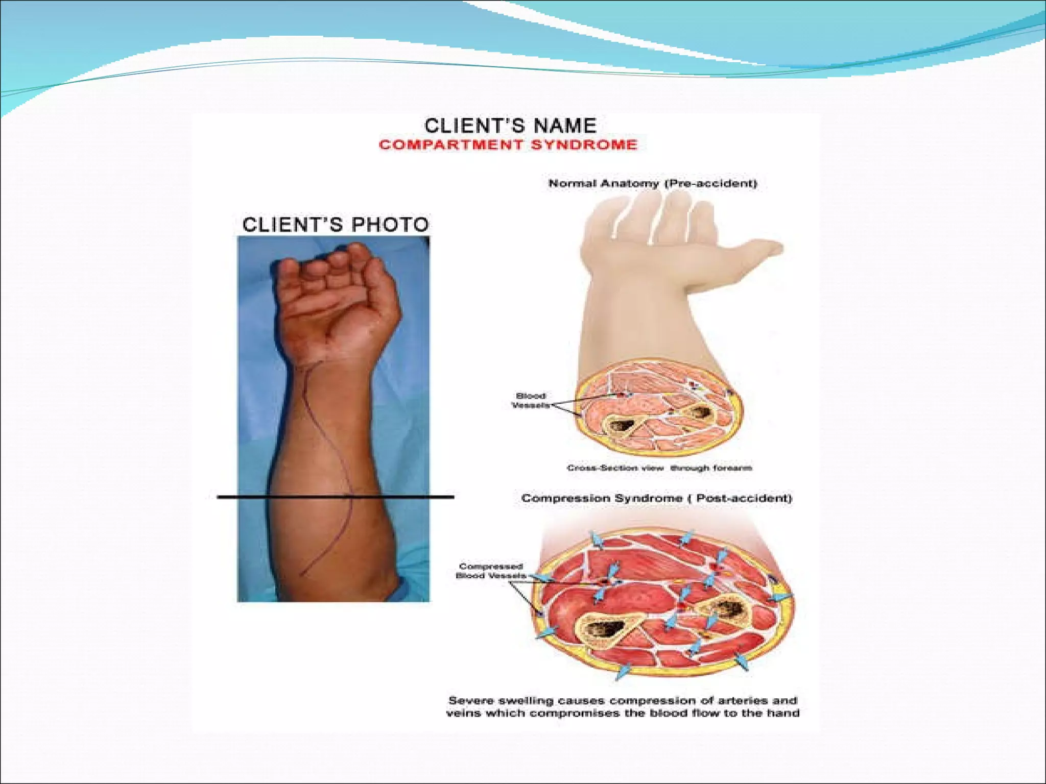 Compression Syndrom Compartment syndrome | PPT