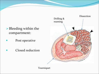 Drilling & reaming Dissection Tourniquet 