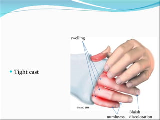 Tight cast swelling Bluish discoloration numbness 
