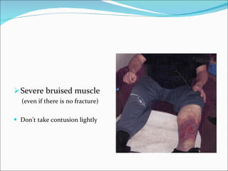 Severe bruised muscle (even if there is no fracture) Don’t take contusion lightly 