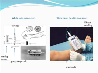 Whiteside maneuver  Wick hand held instrument  syringe 3 way stopcock mmhg mano. electrode Direct reading 