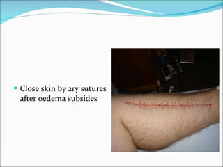 Close skin by 2ry sutures after oedema subsides 