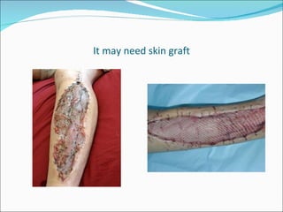 It may need skin graft 