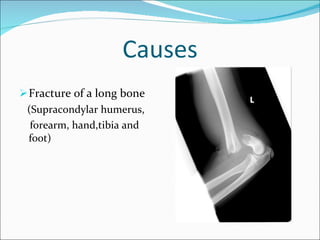 Causes Fracture of a long bone (Supracondylar humerus, forearm, hand,tibia and foot) 