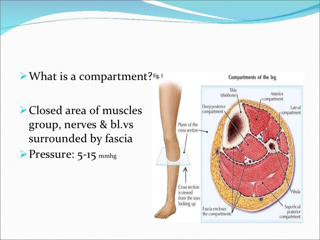 Compartment syndrome