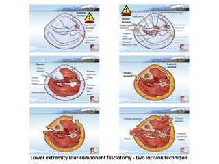 4 Compartmental Decompression Compartment syndrome | PPTX