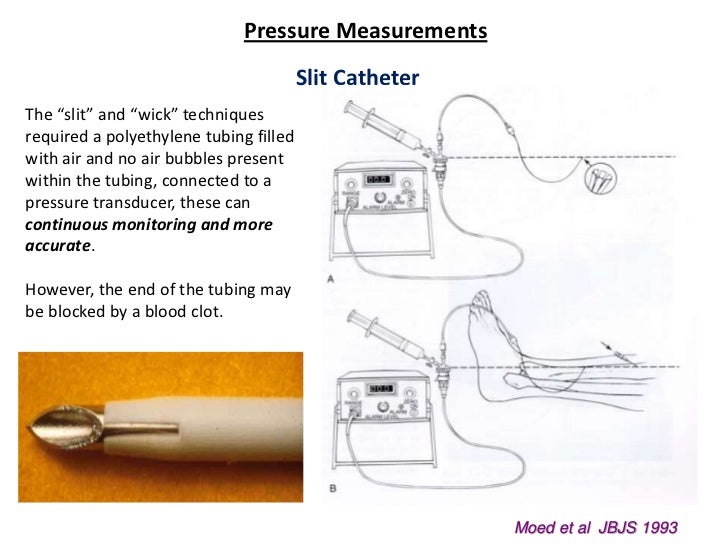 Compartment syndrome