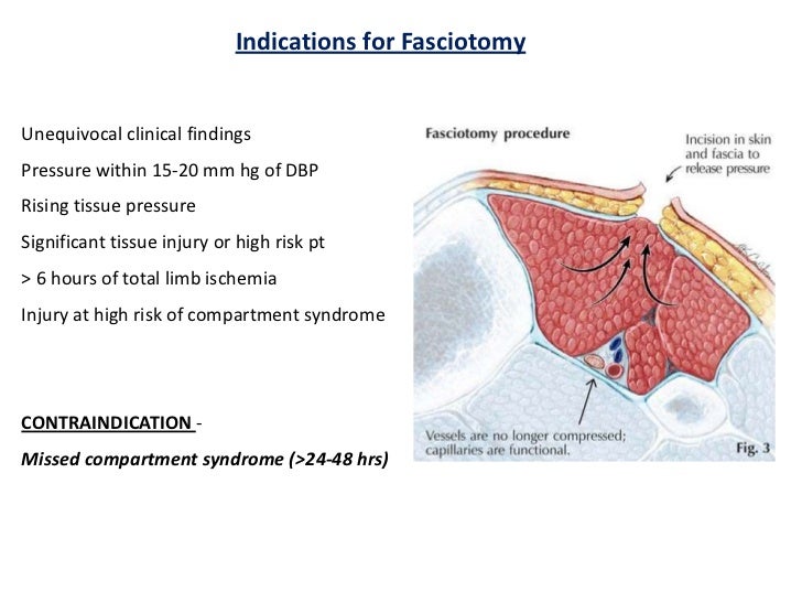 Compartment syndrome