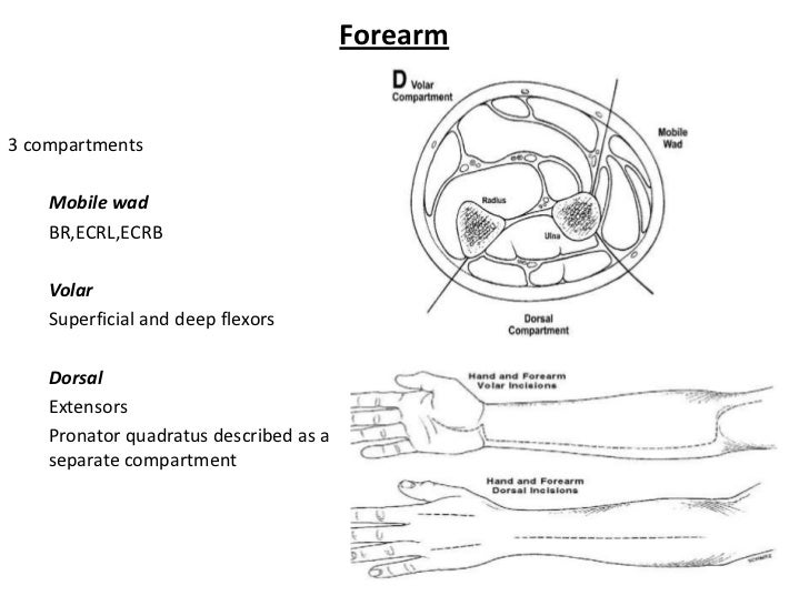 Compartment syndrome