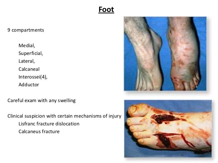 compartment syndrome compartment syndrome