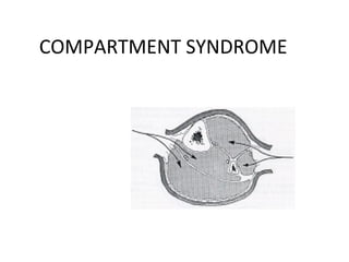 COMPARTMENT SYNDROME
 
