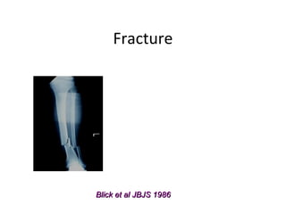 Fracture




Blick et al JBJS 1986
 