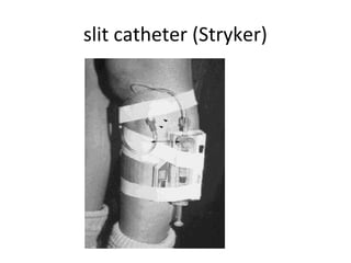 slit catheter (Stryker)
 