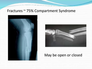 Fractures ~ 75% Compartment Syndrome

May be open or closed

 
