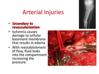 Arterial Injuries
• Secondary to
revascularization:
• Ischemia causes
damage to cellular
basement membrane
that results in edema
• With reestablishment
of flow, fluid leaks
into the compartment
increasing the
pressure.

 
