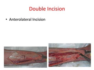 Double Incision
• Anterolateral Incision

 
