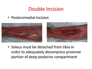 Double Incision
• Posteromedial Incision

• Soleus must be detached from tibia in
order to adequately decompress proximal
portion of deep posterior compartment

 