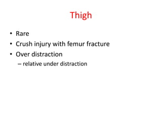 Thigh
• Rare
• Crush injury with femur fracture
• Over distraction
– relative under distraction

 