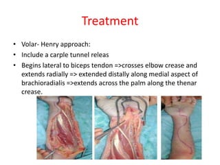 Treatment
• Volar- Henry approach:
• Include a carple tunnel releas
• Begins lateral to biceps tendon =>crosses elbow crease and
extends radially => extended distally along medial aspect of
brachioradialis =>extends across the palm along the thenar
crease.

 