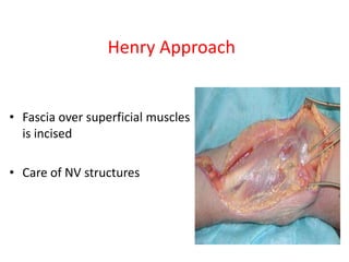 Henry Approach

• Fascia over superficial muscles
is incised
• Care of NV structures

 