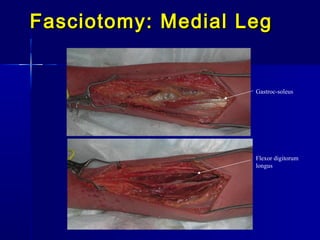 Fasciotomy: Medial LegFasciotomy: Medial Leg
Flexor digitorum 
longus
Gastroc-soleus 
 