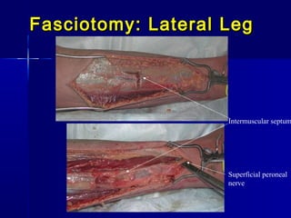 Fasciotomy: Lateral LegFasciotomy: Lateral Leg
Superficial peroneal 
nerve
Intermuscular septum
 