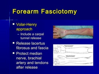 Forearm FasciotomyForearm Fasciotomy
 Volar-HenryVolar-Henry
approachapproach
– Include a carpalInclude a carpal
tunnel releasetunnel release
 Release lacertusRelease lacertus
fibrosus and fasciafibrosus and fascia
 Protect medianProtect median
nerve, brachialnerve, brachial
artery and tendonsartery and tendons
after releaseafter release
 