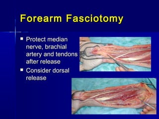 Forearm FasciotomyForearm Fasciotomy
 Protect medianProtect median
nerve, brachialnerve, brachial
artery and tendonsartery and tendons
after releaseafter release
 Consider dorsalConsider dorsal
releaserelease
 