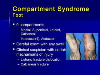 Compartment SyndromeCompartment Syndrome
FootFoot
 9 compartments9 compartments
– Medial, Superficial, Lateral,Medial, Superficial, Lateral,
CalcanealCalcaneal
– Interossei(4), AdductorInterossei(4), Adductor
 Careful exam with any swellingCareful exam with any swelling
 Clinical suspicion with certainClinical suspicion with certain
mechanisms of injurymechanisms of injury
– Lisfranc fracture dislocationLisfranc fracture dislocation
– Calcaneus fractureCalcaneus fracture
 