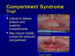 Compartment SyndromeCompartment Syndrome
ThighThigh
 Lateral to releaseLateral to release
anterior andanterior and
posteriorposterior
compartmentscompartments
 May require medialMay require medial
incision for adductorincision for adductor
compartmentcompartment
Lateral septum
Vastus lateralis
 