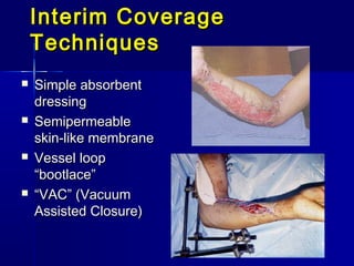 Interim CoverageInterim Coverage
TechniquesTechniques
 Simple absorbentSimple absorbent
dressingdressing
 SemipermeableSemipermeable
skin-like membraneskin-like membrane
 Vessel loopVessel loop
“bootlace”“bootlace”
 ““VAC” (VacuumVAC” (Vacuum
Assisted Closure)Assisted Closure)
 