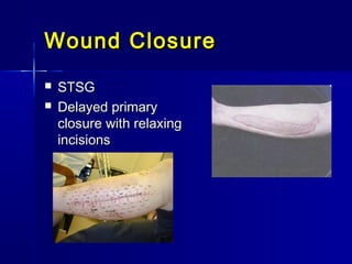 Wound ClosureWound Closure
 STSGSTSG
 Delayed primaryDelayed primary
closure with relaxingclosure with relaxing
incisionsincisions
 