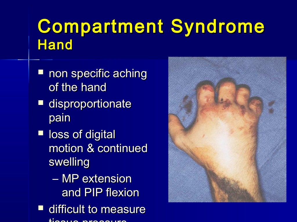 Compartment syndrome