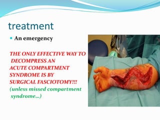 treatment
 An emergency
THE ONLY EFFECTIVE WAY TO
DECOMPRESS AN
ACUTE COMPARTMENT
SYNDROME IS BY
SURGICAL FASCIOTOMY!!!
(unless missed compartment
syndrome…)
 